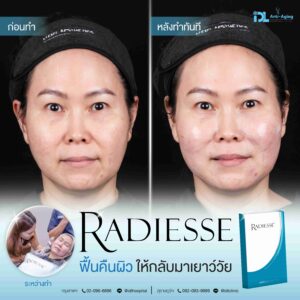 Radiesse