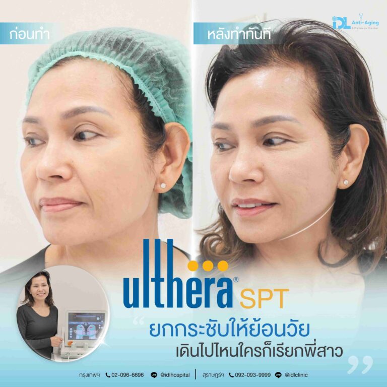 review ulthera