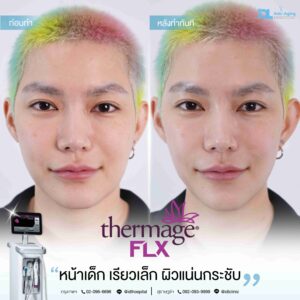 Thermage Flx หน้าเด็ก เรียวเล็ก ผิวแน่นกระชับ