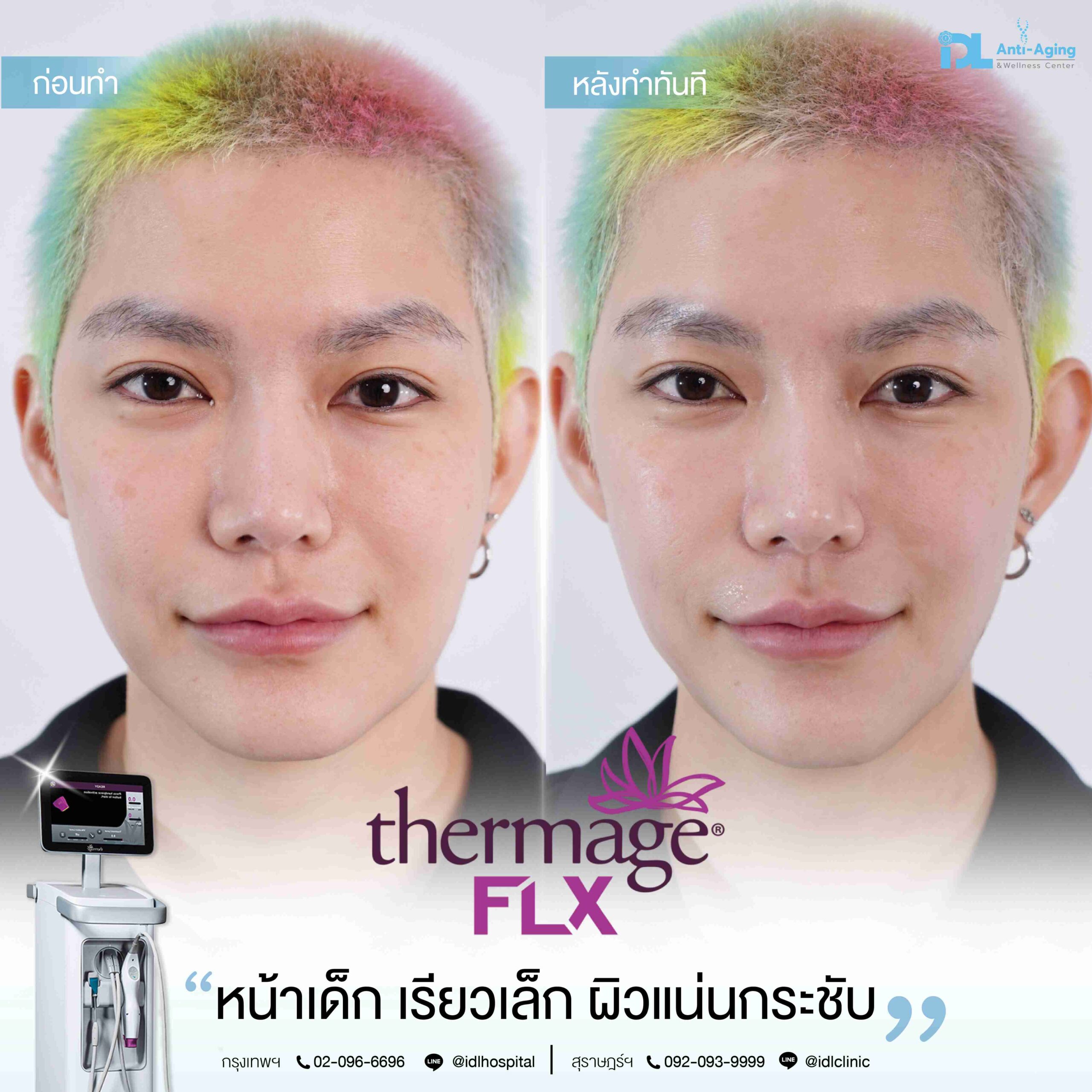 Thermage Flx หน้าเด็ก เรียวเล็ก ผิวแน่นกระชับ