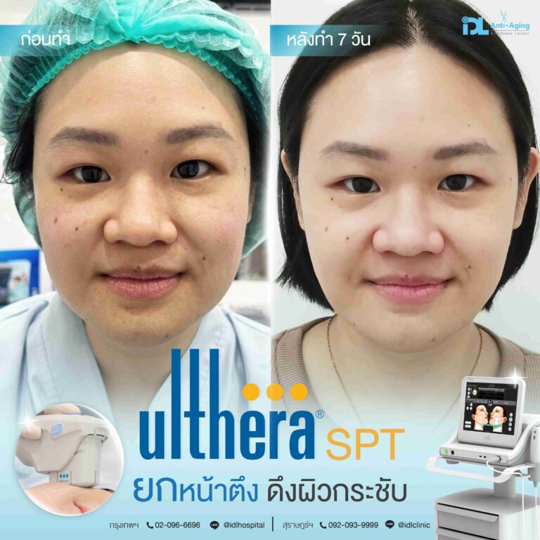 review ulthera