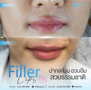 Filler