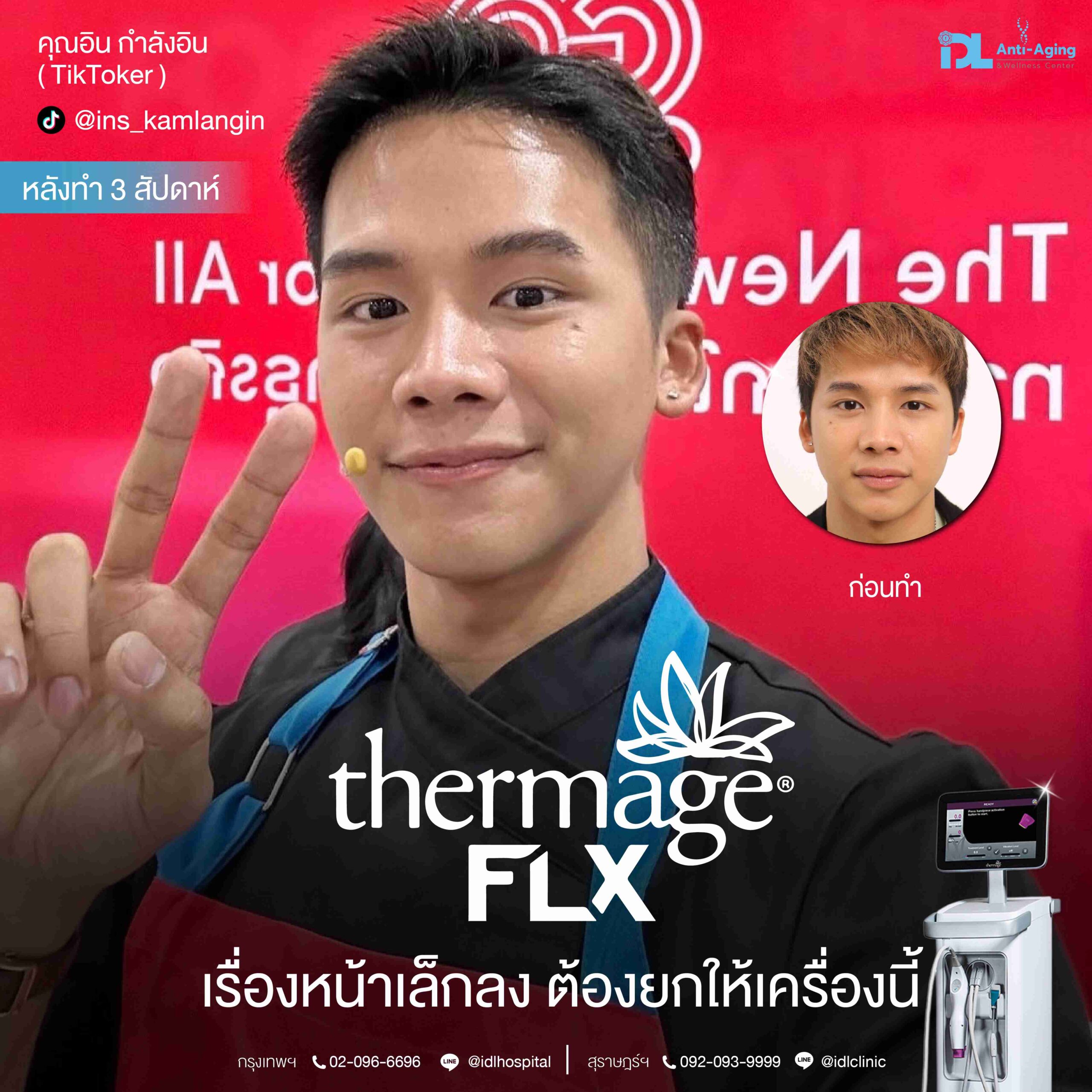 thermage flx หน้าเล็ดต้องเครื่องนี้