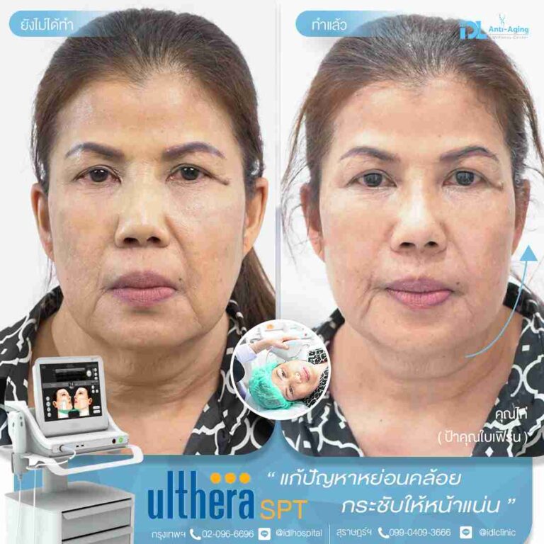 review ulthera