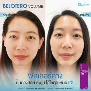 Filler Belotero