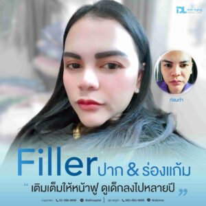Filler