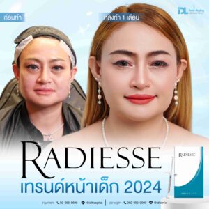 Radiesse