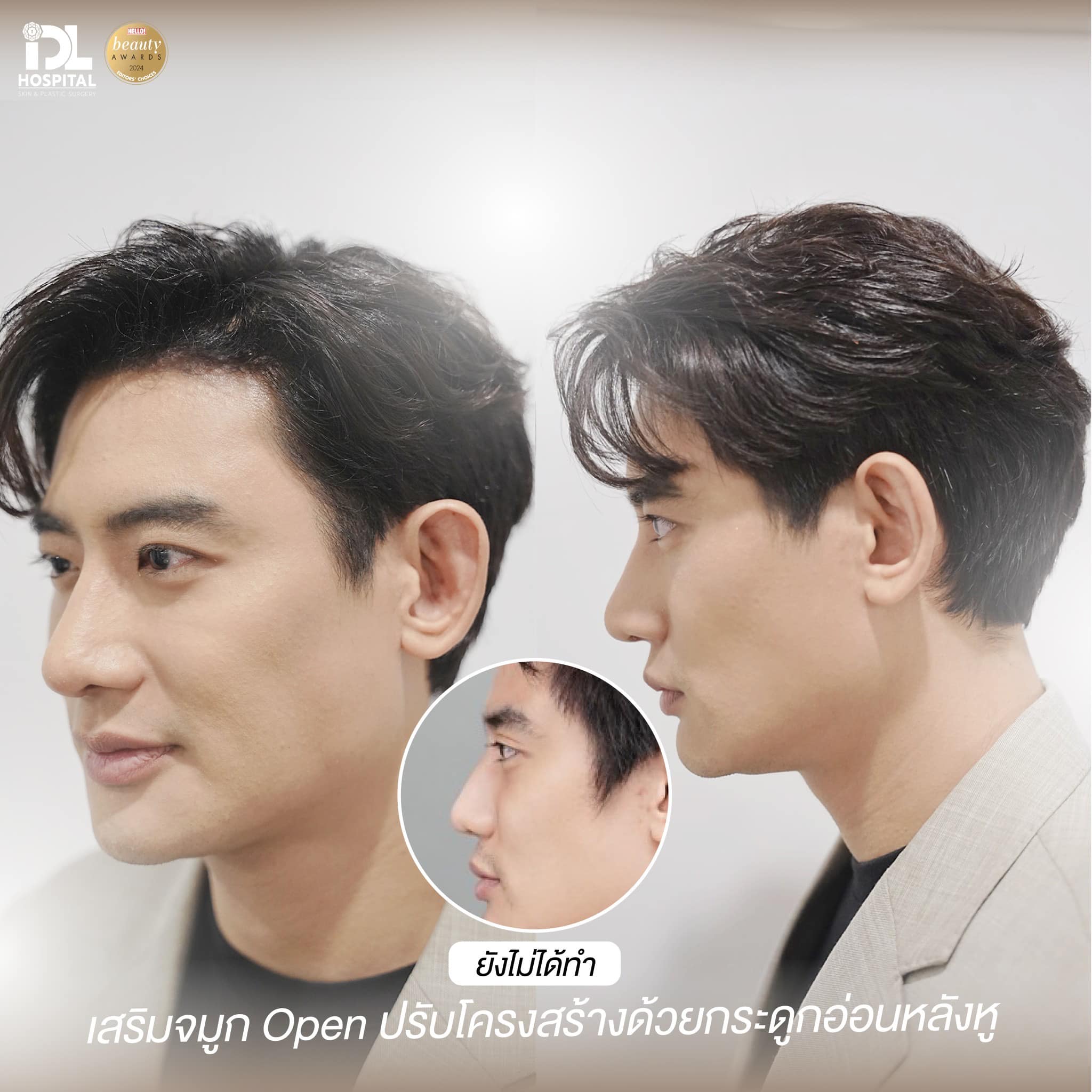 เสริมจมูกผู้ชายกับ