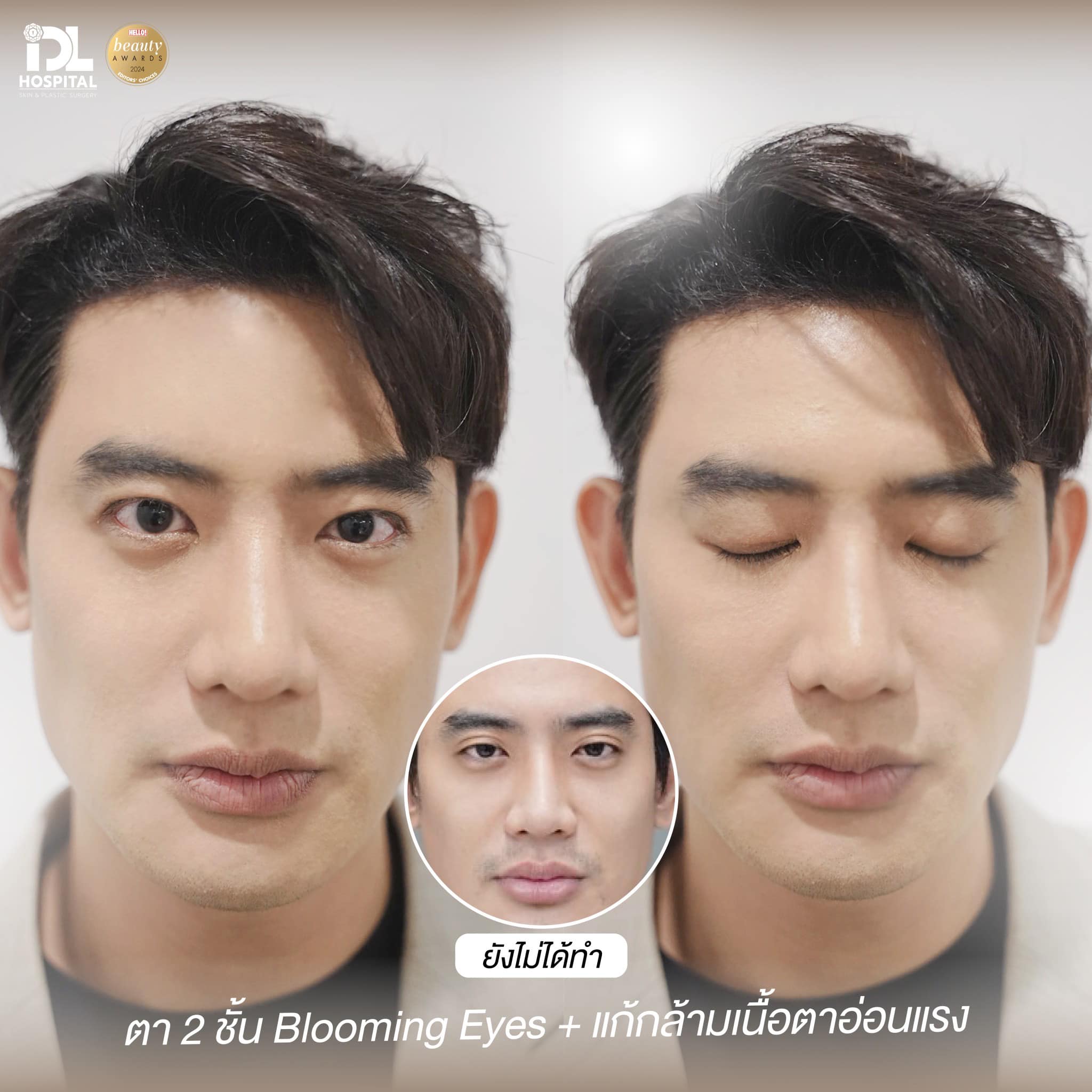 Big Thongpoom ตาสองชั้น จมูก Open