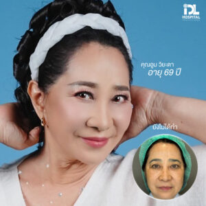 รีวิว ดึงหน้า IDL