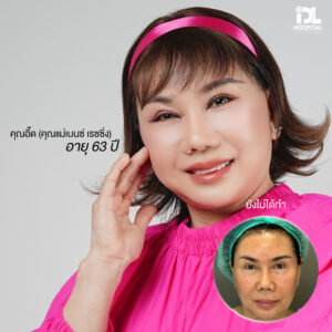 รีวิว ดึงหน้า IDL