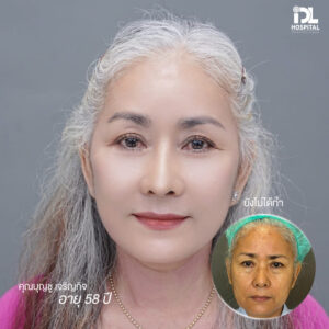 รีวิว ดึงหน้า IDL