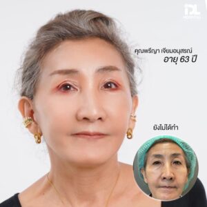 รีวิว ดึงหน้า IDL