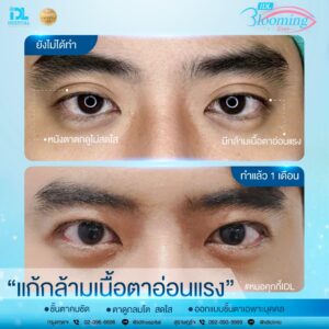 รีวิว ตาสองชั้น IDL