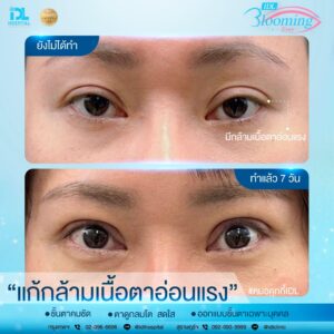 รีวิว ตาสองชั้น IDL