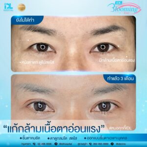 รีวิว ตาสองชั้น IDL