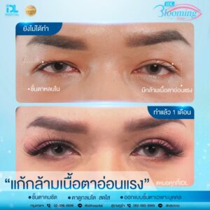 รีวิว ตาสองชั้น IDL