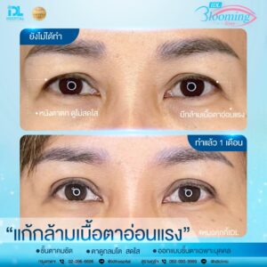 รีวิว ตาสองชั้น IDL