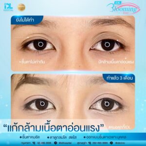 รีวิว ตาสองชั้น IDL