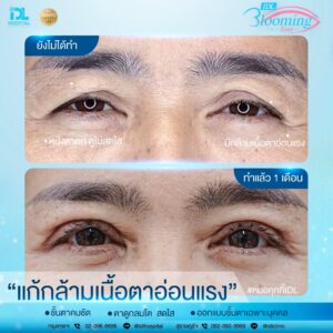 รีวิว ตาสองชั้น IDL