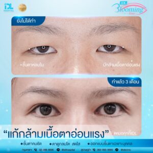 รีวิว ตาสองชั้น IDL