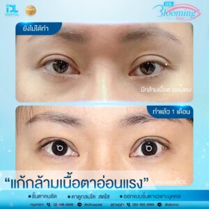 รีวิว ตาสองชั้น IDL