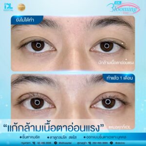 รีวิว ตาสองชั้น IDL