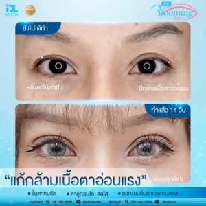 รีวิว ตาสองชั้น IDL