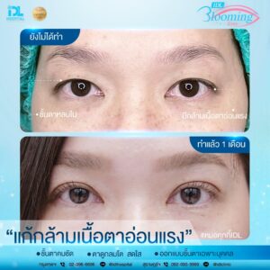 รีวิว ตาสองชั้น IDL