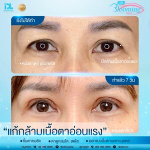 รีวิว ตาสองชั้น IDL