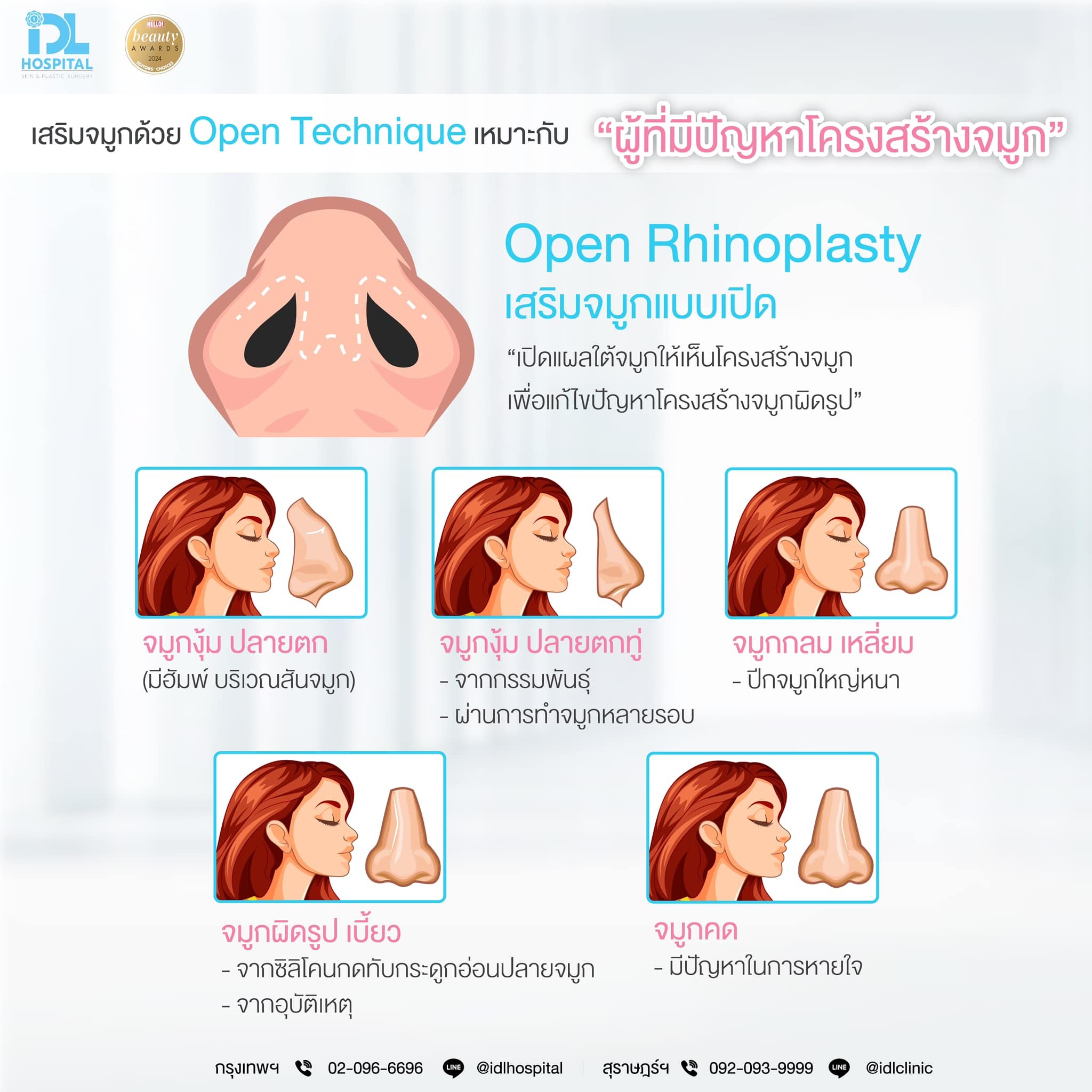 เสริมจมูก Open