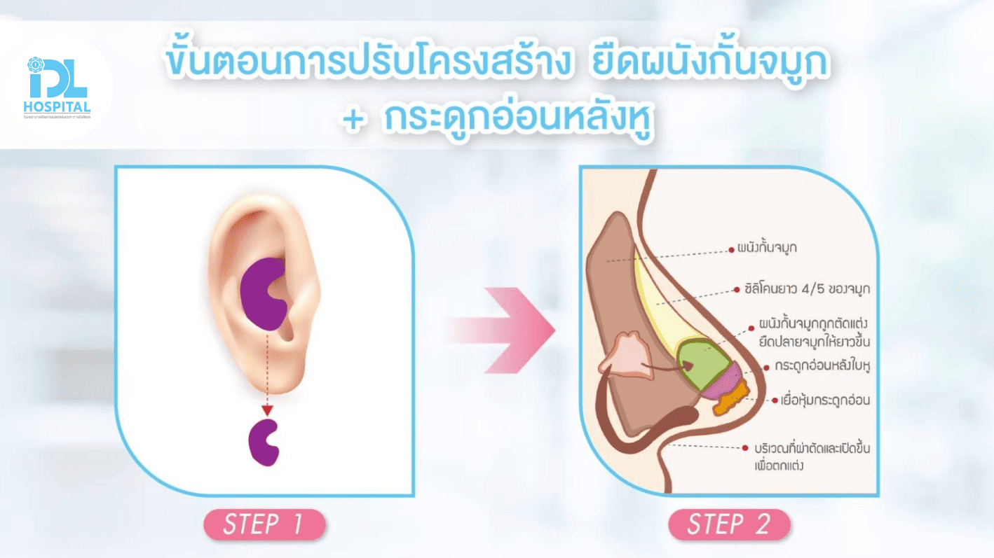 ขั้นตอนการปรับโครงสร้าง กระดูดอ่อนหลังหู