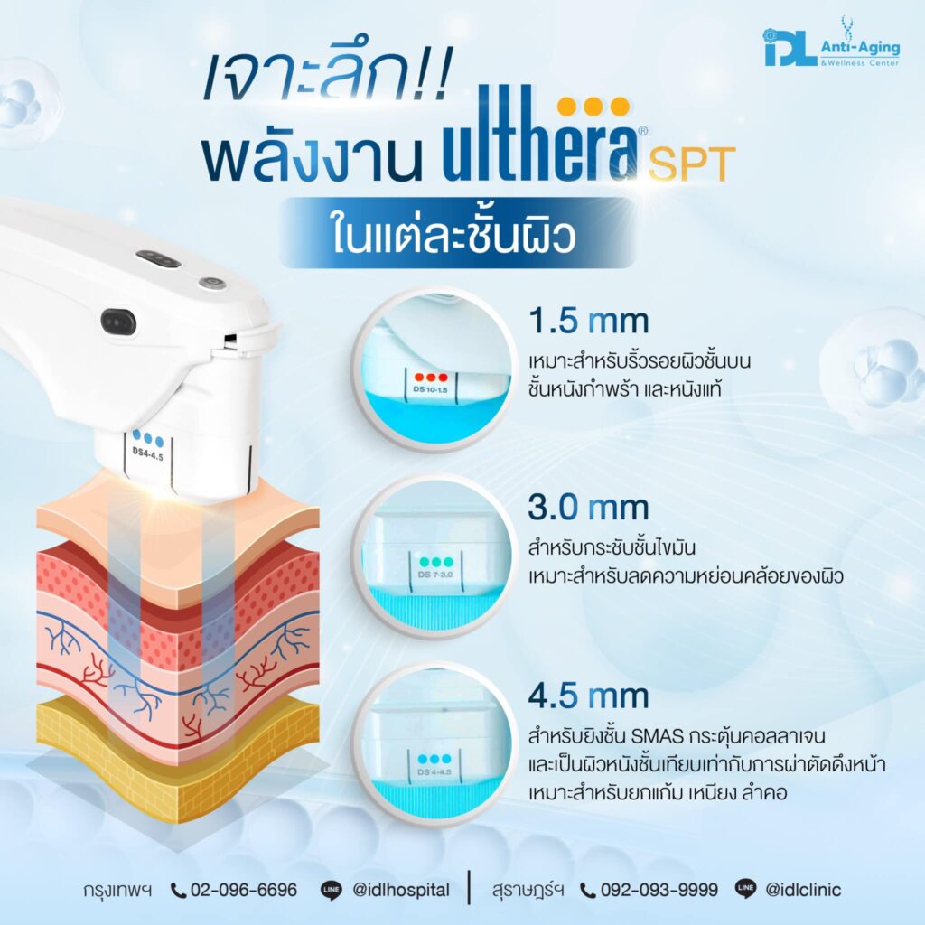 หัวของ ulthera มีกี่แบบ
