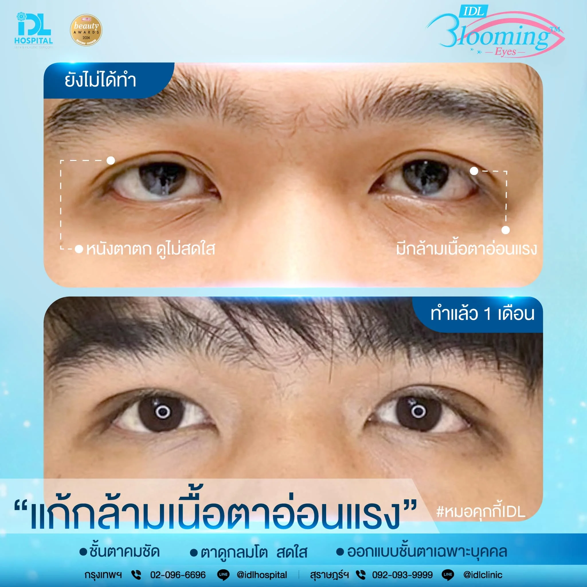 รีวิวทำตาแก้เบ้าตาลึกเหมือนคนง่วงนอน