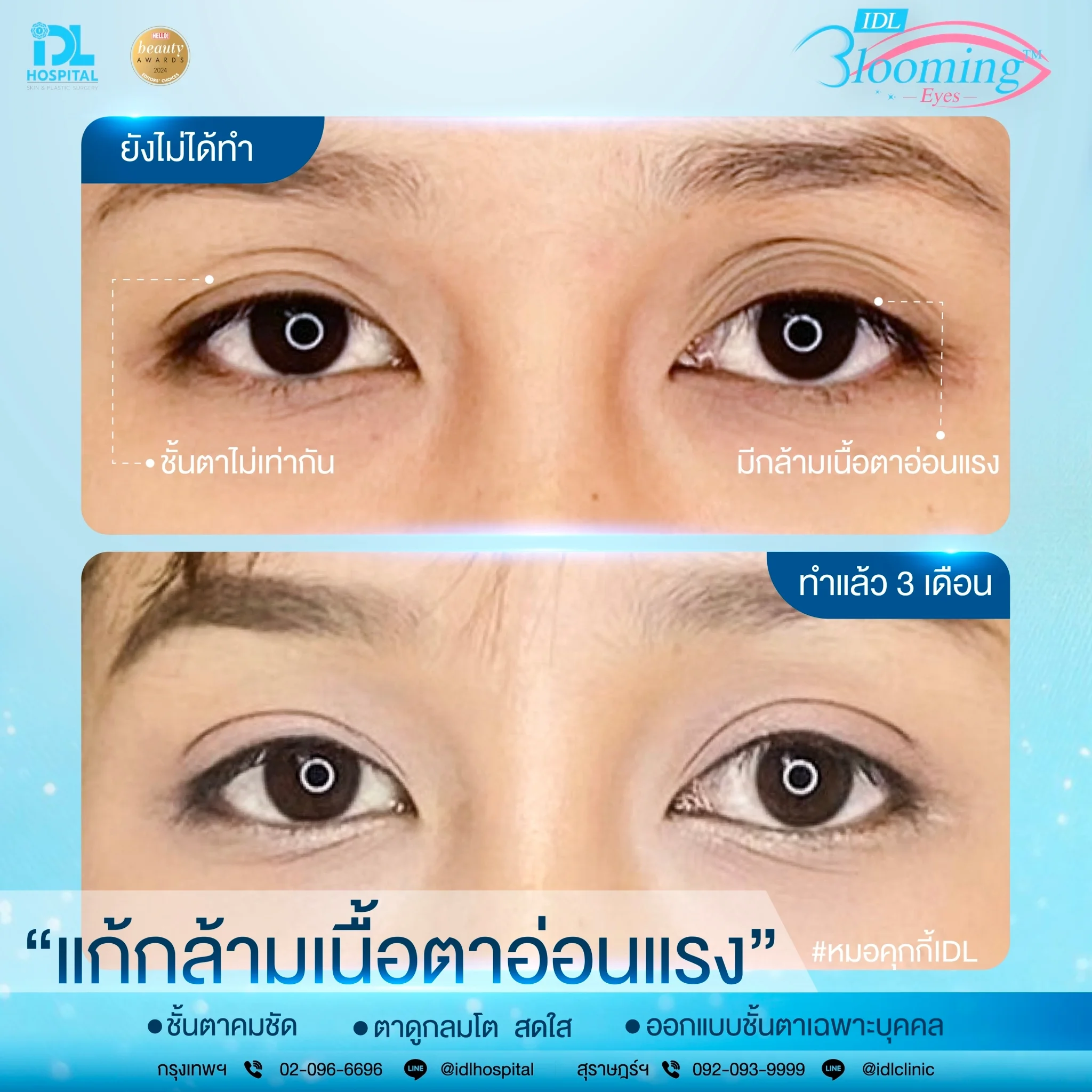 รีวิวทำตาแก้ชั้นตาสองข้างไม่เท่ากัน