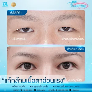 รีวิวทำตา 2 ชั้นกับ IDL Hospital