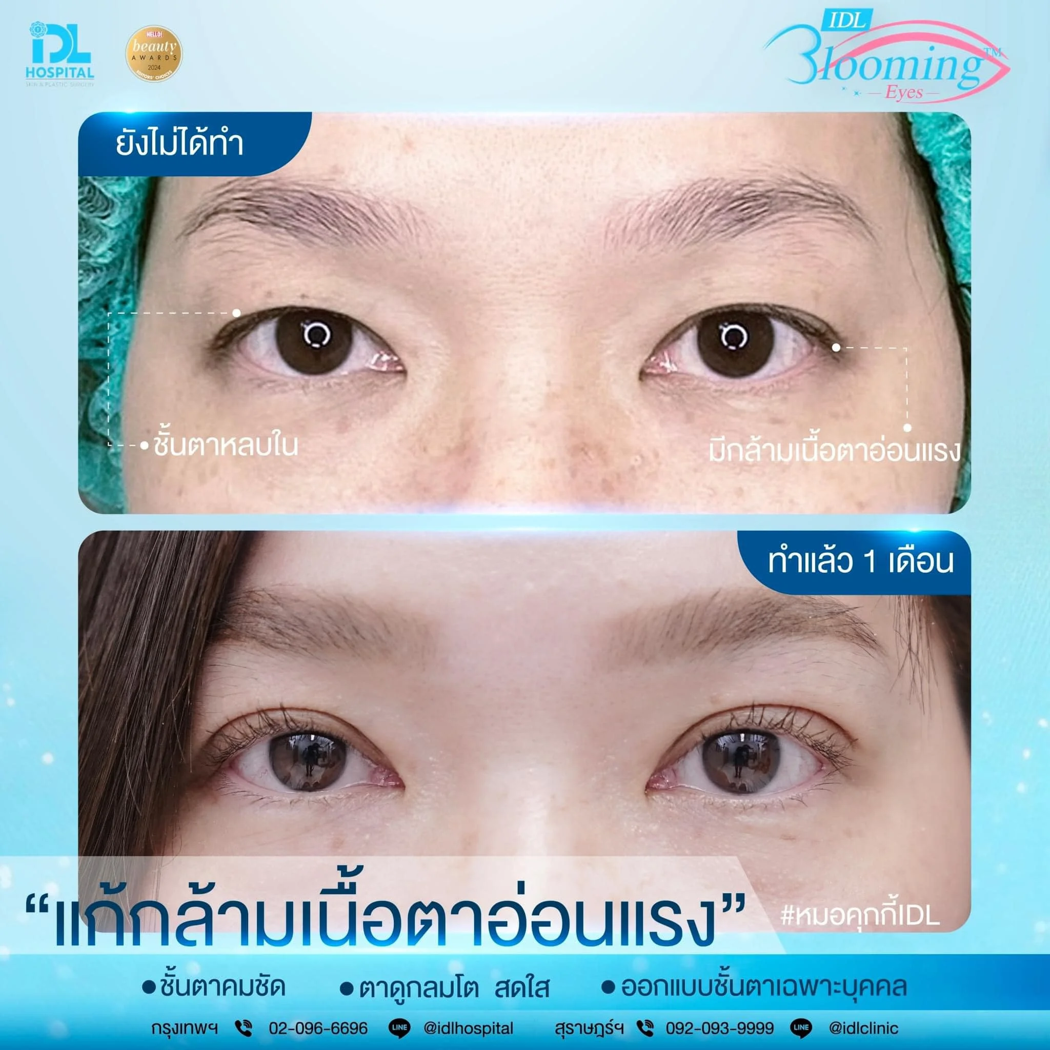 รีวิวทำตา 2 ชั้นกับ IDL Hospital