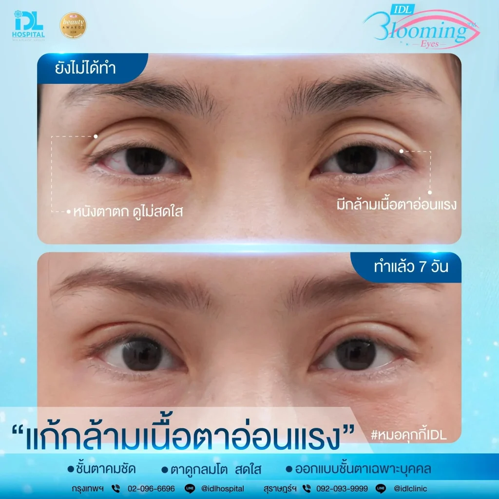 รวมเคสรีวิวจากลูกค้าจริงที่ IDL Hospital