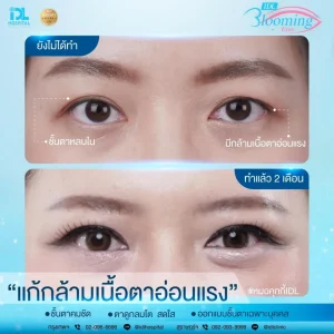 รีวิวทำตา 2 ชั้นกับ IDL Hospital