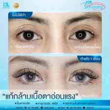 รวมเคสรีวิวจากลูกค้าจริงที่ IDL Hospital