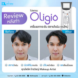 โปร Oligio