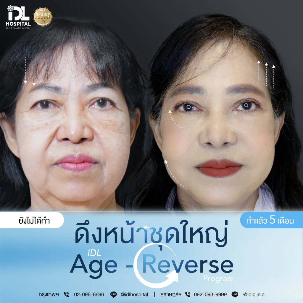 รีวิวลูกค้าที่ดึงหน้าด้วยเทคนิค Endotine
