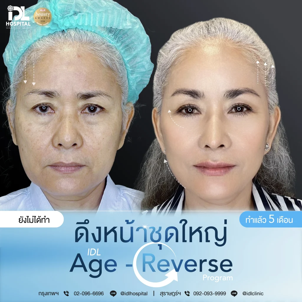รีวิวลูกค้าที่ดึงหน้าด้วยเทคนิค Endotine