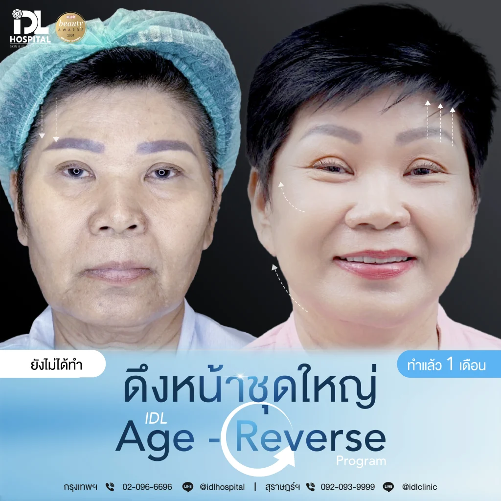 รีวิวลูกค้าที่ดึงหน้าด้วยเทคนิค Endotine
