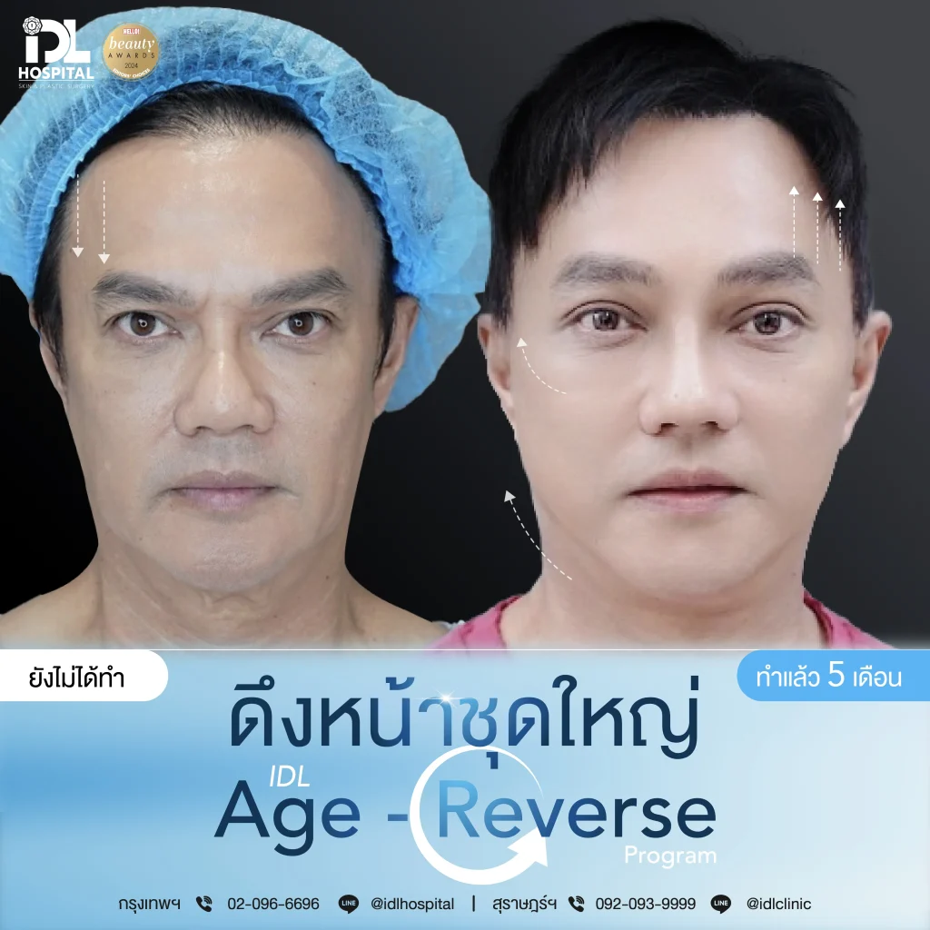 รีวิวลูกค้าที่ดึงหน้าด้วยเทคนิค Endotine