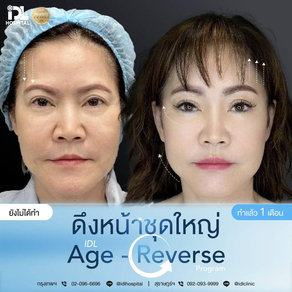 รีวิวลูกค้าที่ดึงหน้าด้วยเทคนิค Endotine