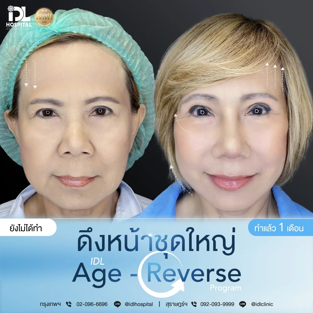 รีวิวลูกค้าที่ดึงหน้าด้วยเทคนิค Endotine