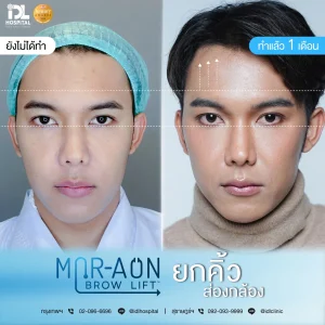 รีวิวลูกค้าที่ทำศัลยกรรมยกคิ้ว