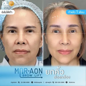 รีวิวลูกค้าที่ทำศัลยกรรมยกคิ้ว