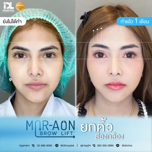 รีวิวลูกค้าที่ทำศัลยกรรมยกคิ้ว